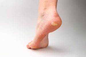 Bacterial Foot Infection In Uptown