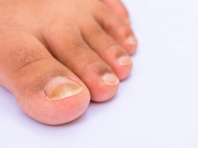 Toenail Infection In Uptown