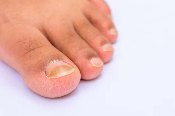 Toenail Infection In Uptown